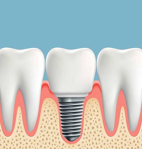 Dental Implants in West Lethbridge
