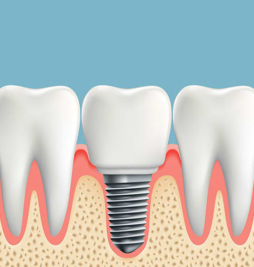 Dental Implants in West Lethbridge